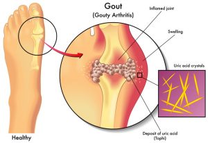 how-to-remove-uric-acid-crystallization-in-joints-wp-fb