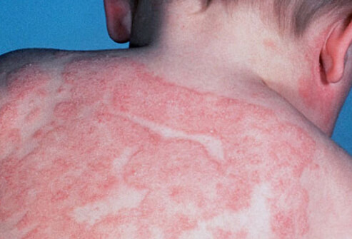 baby_skin_care_s6_dermatitis_eczema