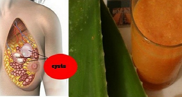 Eliminate Breast Cyst