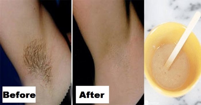 You-only-need-2-ingredients-and-2-minutes-to-get-rid-of-underarm-hair-forever