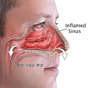 inflamed-sinus-infection